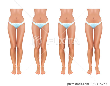 vector illustration of orthopedics. valgus and varus vector illustration of orthopedics. valgus and varus 49415244