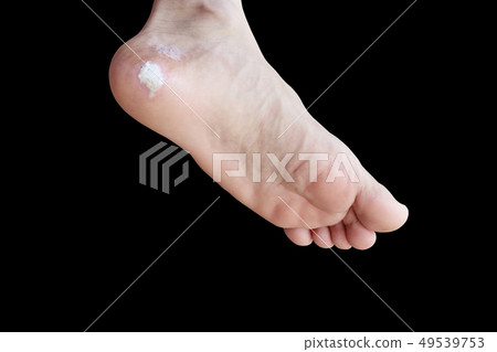 close up pain foot corn isolated on black close up pain foot corn isolated on black 49539753