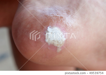 close up pain foot corn close up pain foot corn 49539754