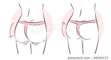butt implant before and after 49589157