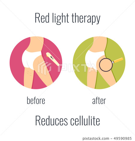 Illustration of a girl with cellullite and without Illustration of a girl with cellullite and without 49590985