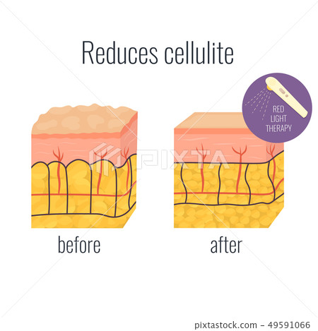Cell illustration with cellullite and without. 49591066