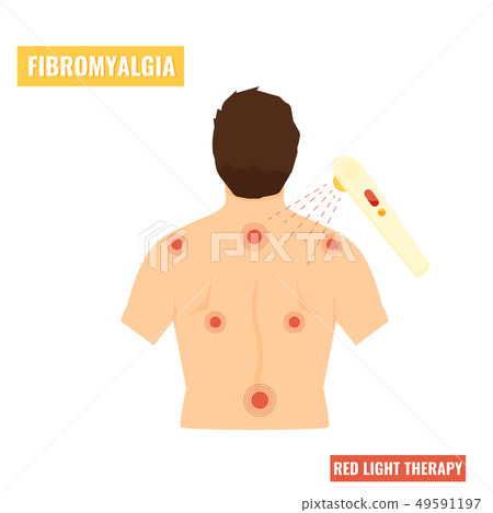 Fibromyalgia disease. Red light therapy 49591197