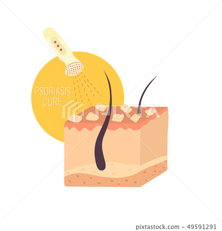 Psoriasis treatment. Skin problem. Psoriasis treatment. Skin problem. 49591291