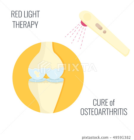 Osteoarthritis illustration. Red light therapy 49591382