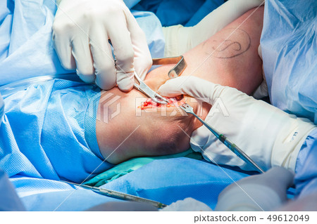 Surgeons performing surgery on a patient arm Surgeons performing surgery on a patient arm 49612049