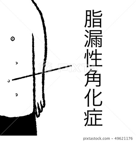 脂溢性角化病 脂溢性角化病 49621176