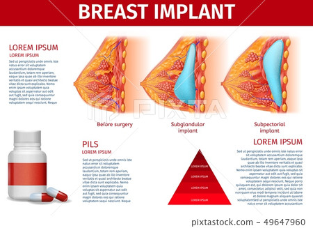 Breast Implant Anatomical Banner, Copy Space. 49647960