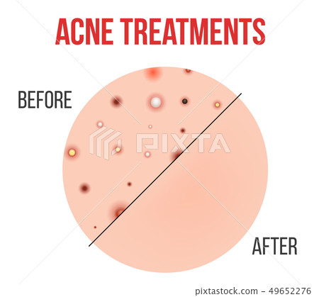 Creative illustration types of acne, pimples, skin pores, blackhead, whitehead, scar, comedone 49652276