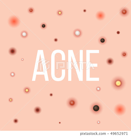 Creative illustration types of acne, pimples, skin pores, blackhead, whitehead, scar, comedone 49652971