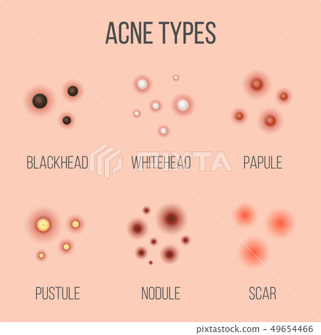 Creative Illustration Types Of Acne Pimples Stock Illustration 49654466 Pixta