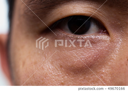 Ptosis (Droopy eyelid) in asian male oily skin Ptosis (Droopy eyelid) in asian male oily skin 49670166