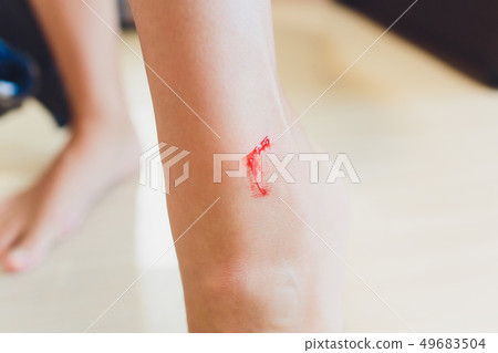 The leg is wound with bleeding caused by scratching. 49683504