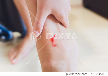 The leg is wound with bleeding caused by scratching. 49683506