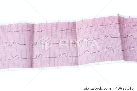 ECG with acute period of myocardial infarction 49685116
