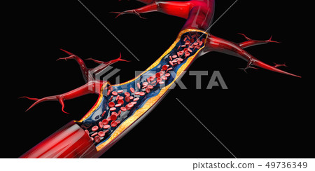 3d Illustration of blood cells with plaque buildup of cholesterol isolated black 3d Illustration of blood cells with plaque buildup of cholesterol isolated black 49736349