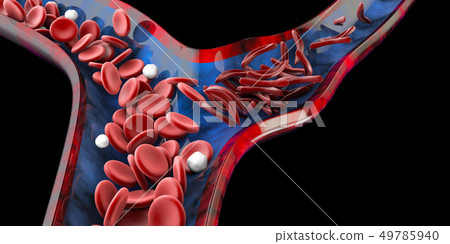 Sickle cell anemia, showing blood vessel with normal and deformated crescent. 3D illustration 49785940