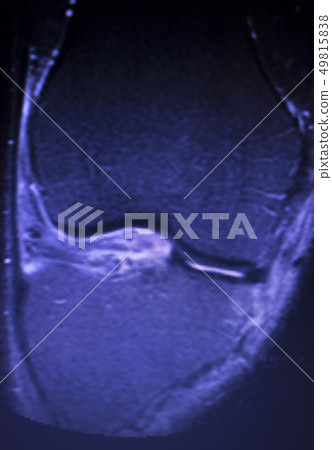 MRI knee meniscus tear scan 49815838
