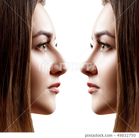 Young woman in profile before and after rhinoplasty. Young woman in profile before and after rhinoplasty. 49832750