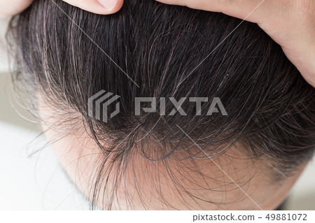 Male scalp hairline - Stock Photo [49881072] - PIXTA