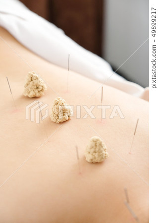 Needles and chopsticks stabbed on the back of a woman in a bright acupuncture clinic 49899217