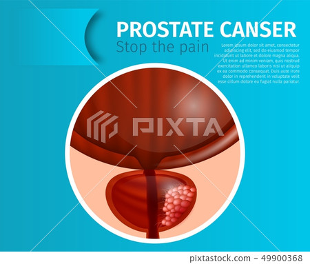 Prostate Cancer Stop The Pain Urological Banner Stock