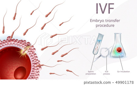 In Vitro Fertilization Embryo Transfer Procedure. 49901178