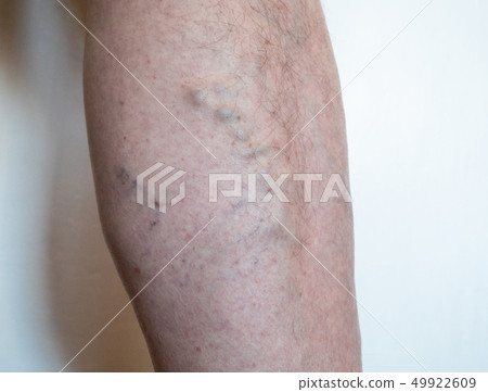 leg of old man with varicose veins - enlarged, 49922609