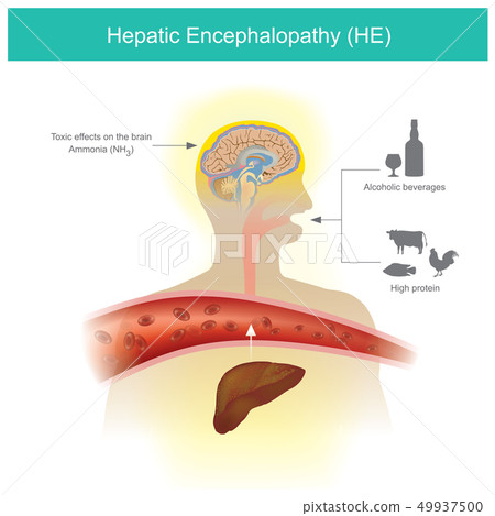 Hepatic Encephalopathy 49937500