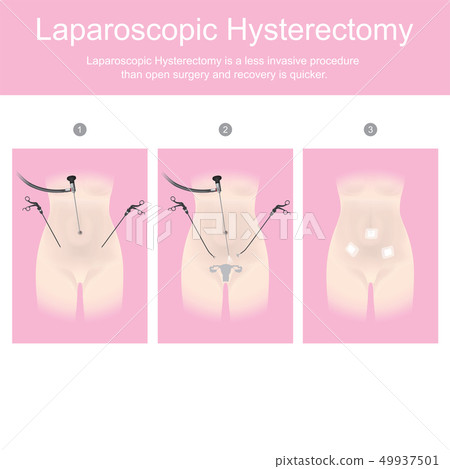 Laparoscopic hysterectomy is a less invasive 49937501