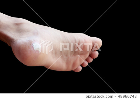 close up pain foot corn isolated on black close up pain foot corn isolated on black 49966748