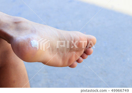close up male foot pain foot corn close up male foot pain foot corn 49966749
