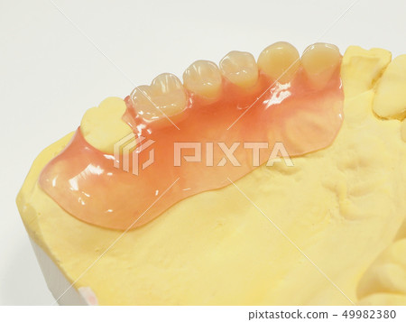 Non-clasp denture upper right side 6, 5, 4, 3, 2 Non-clasp denture upper right side 6, 5, 4, 3, 2 49982380