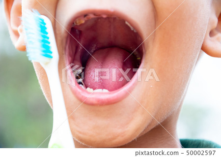 Boy or children have problem teeth about caries Boy or children have problem teeth about caries 50002597