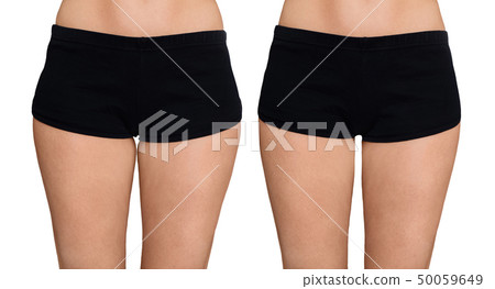 Female buttocks before and after treatment. Female buttocks before and after treatment. 50059649