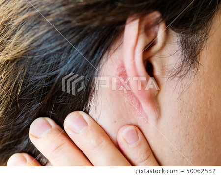 Irritation on the skin behind the ear. Man  50062532