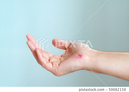 scratch wound on female hand closeup, healthcare 50082138