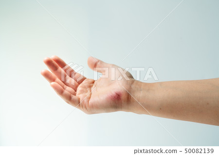 scratch wound on female hand closeup, healthcare 50082139