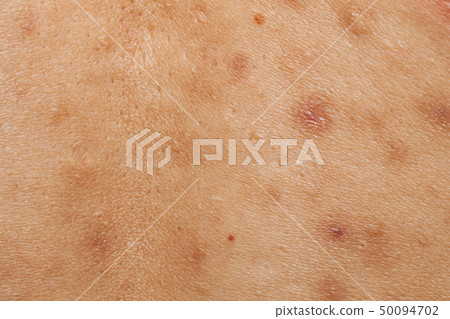 Boy with problematic skin and acne scars in back 50094702