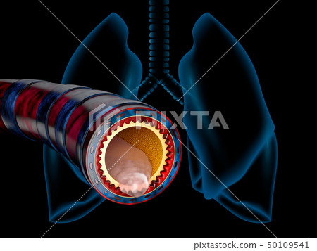 Bronchitis anatomy, mucus secreted as a chest cold as a 3D illustration Bronchitis anatomy, mucus secreted as a chest cold as a 3D illustration 50109541