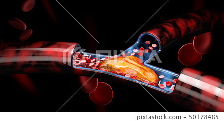 3d Illustration of Deep Vein Thrombosis or Blood Clots, Embolism. 50178485