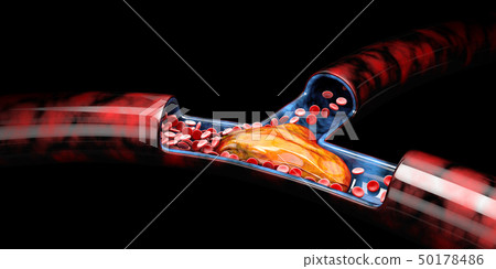 3d Illustration of Deep Vein Thrombosis or Blood Clots, Embolism isolated black 3d Illustration of Deep Vein Thrombosis or Blood Clots, Embolism isolated black 50178486