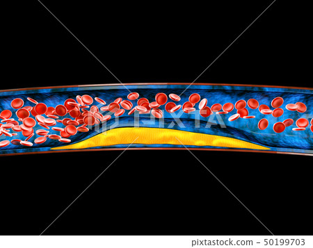 3d Illustration of blood cells with plaque buildup of cholesterol 50199703