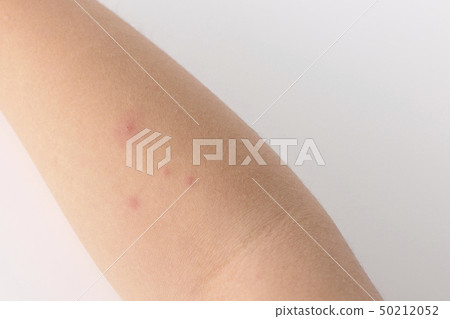 水痘 水痘 50212052