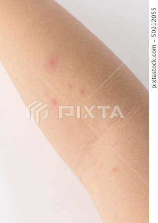 水痘 水痘 50212055