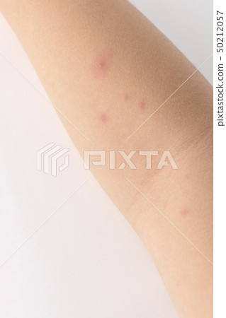 chicken pox chicken pox 50212057