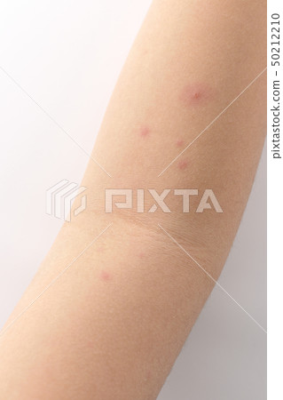 chicken pox 50212210