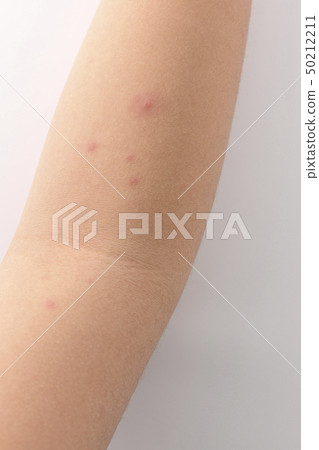 chicken pox 50212211