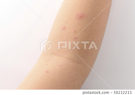 chicken pox chicken pox 50212213