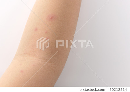 chicken pox 50212214